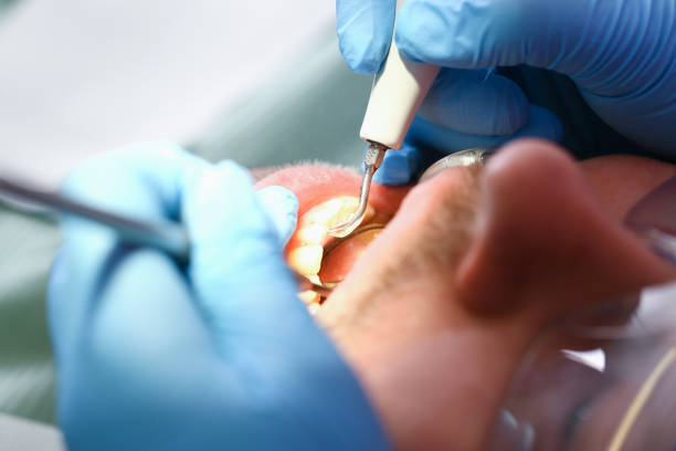 Best Emergency Root Canal Treatment in Steelevle, IL