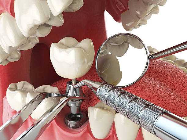 Best Emergency Treatment for Toothache in Steelevle, IL
